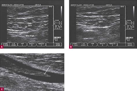 Venous Imaging/Duplex Ultrasound | Plastic Surgery Key