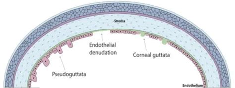 Cornea Guttata: Symptoms And Treatment | How Relate To Phaco