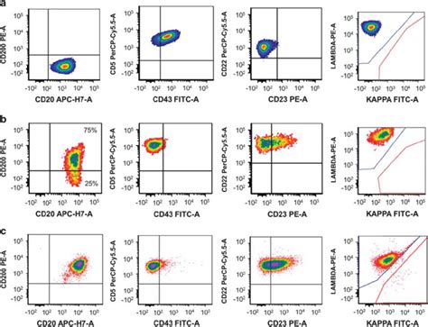 Examples Of CD200 Expression In Mantle Cell Lymphoma By Flow Cytometry