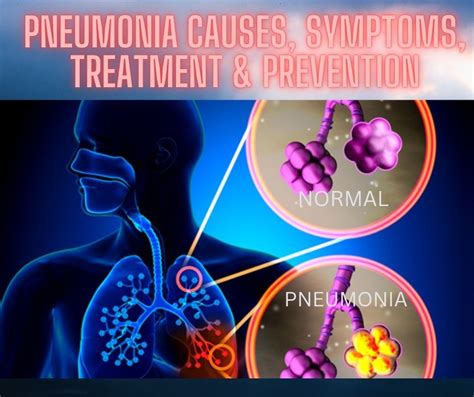 Pneumonia Causes Symptoms And Treatment Healthy Life With Dr Shaista