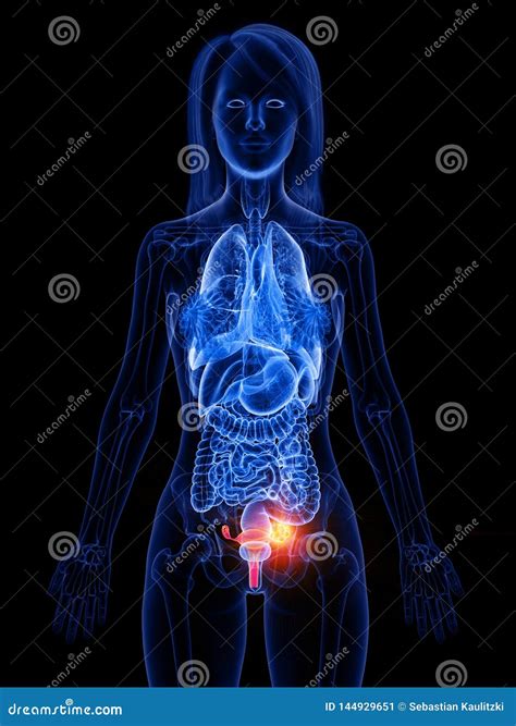 A Womans Uterus Tumor Stock Illustration Illustration Of Ovary 144929651