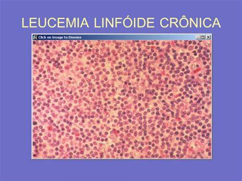 Leucemia Linfóide Crônica 2 CBN Campinas 99 1 FM