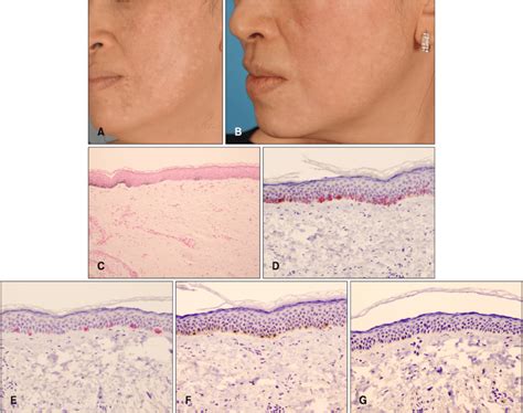 A Guttate Hypopigmented Macules On The Face Of The Patient In Case 1