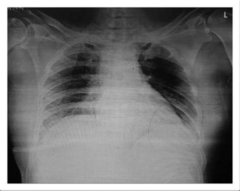 Chest Radiograph Showing Completely Expanded Lung And Icd In Situ