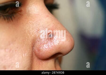 Inflamed Pimple On Nose Cyst Acne Acne On The Skin Stock Photo Alamy