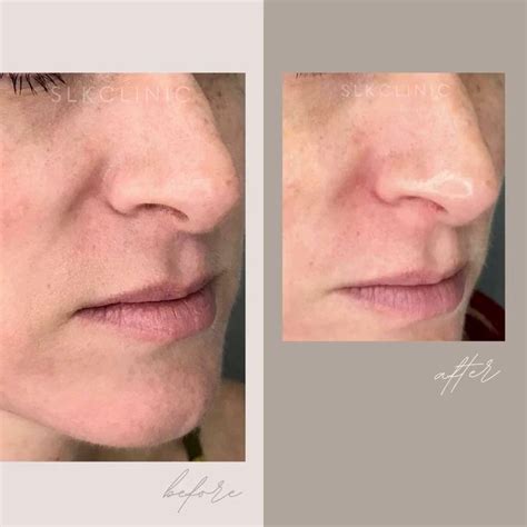 Facial Rejuvenation Nasolabial Fold Filler [video] Nasolabial Folds