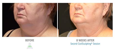 Top Double Chin Treatments In New York Dr Ariel Ostad Md