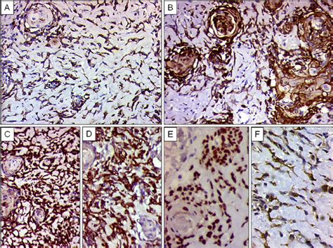 Ihc Findings A Tumor Cells Showing Diffuse Ema Positivity Dab