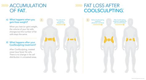 WHAT IS COOLSCULPTING? – BURN BODY FAT INSTANTLY