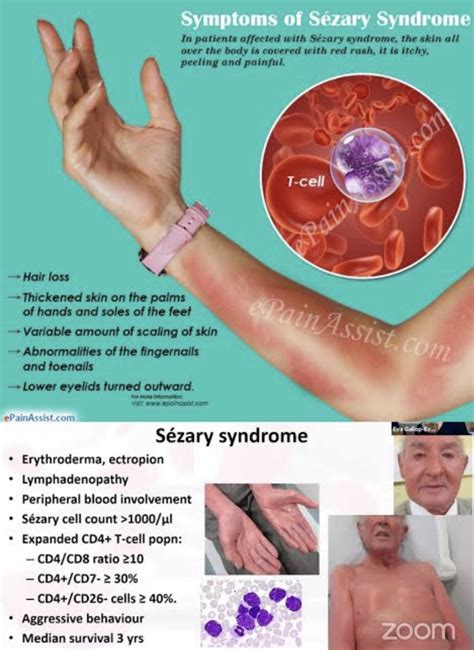Cancerous Red Skin Lesion Due To T Cell Lymphoma Phot