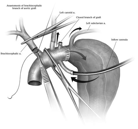 Aortic Root Reconstruction And Valve Repair During Acute Type A Aortic