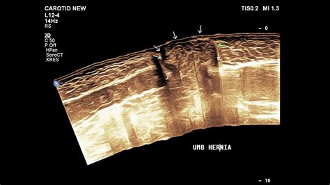 Umbilical Hernia Ultrasound Case 06 Youtube