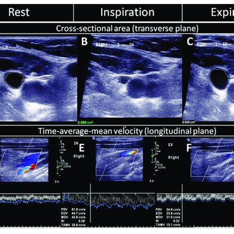 Display Of Doppler Spectra Of The Ijv Internal Jugular Vein During Download Scientific