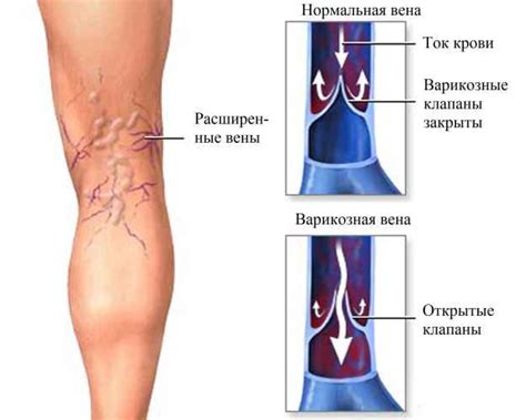 Подути вени по краката