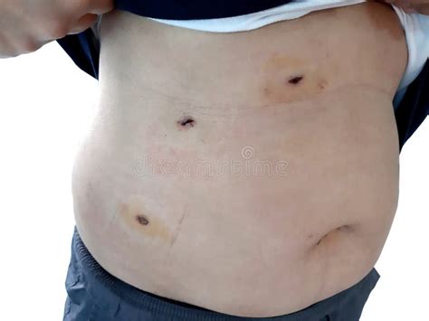 Scars From Gallbladder Surgery Stock Image Image Of Cholecystectomy Appendix 305900267