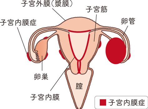 子宮内膜症｜おしえて 子宮・卵巣のコト【中外製薬】