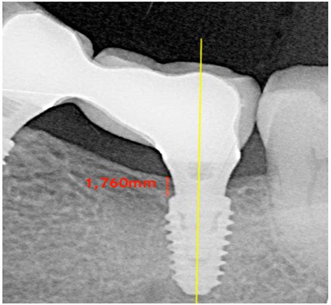 Jcm Free Full Text Factors Influencing Early Marginal Bone Loss Around Dental Implants