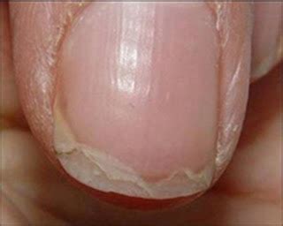 Nails with ridges vitamin deficiency - Awesome Nail