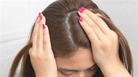 4 Cara Menghilangkan Kutu Rambut Dan Telurnya Dengan Cepat