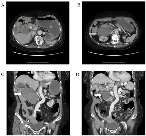 Frontiers Case Report Duodenal Obstruction Caused By Gastroduodenal Artery Pseudoaneurysm