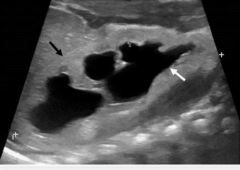 Pdf Megacystis Microcolon Intestinal Hypoperistalsis Syndrome A Case