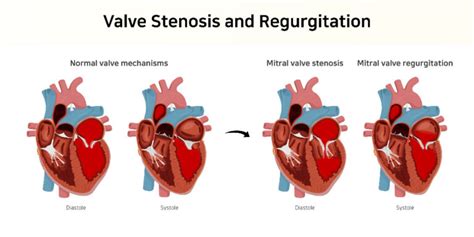 Mitral Valve Diseases Types, Symptoms and Treatment| Dr Raghu