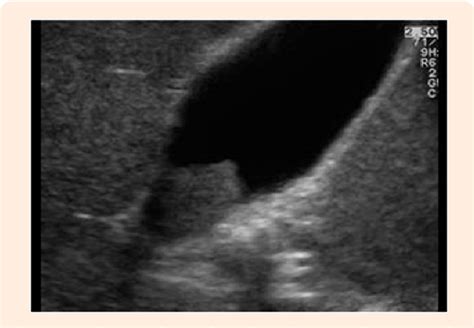 Figure 1 From Gallbladder Polyps Surgical Indications According To