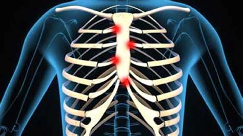 Understanding Costochondritis Symptoms Diagnosis And Treatment