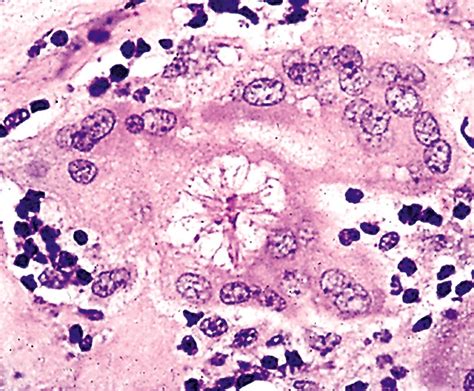 Pathology Outlines Sarcoidosis