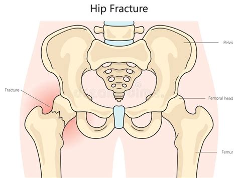 Hip Fracture Structure Diagram Medical Science Stock Vector