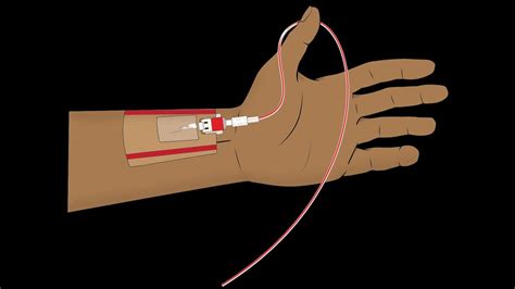 Arterial Catheterization Cpt Code Simplify Medical Coding Youtube