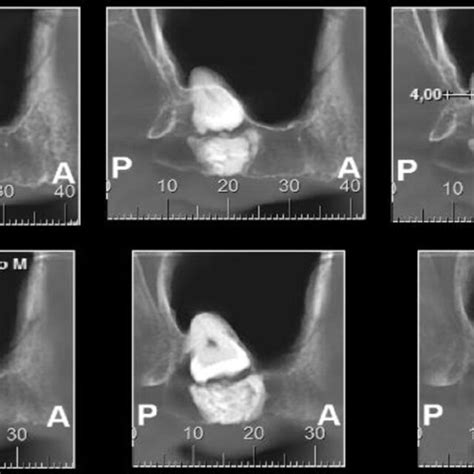 Initial Cone Beam Computed Tomography Image Of The Left Maxillary