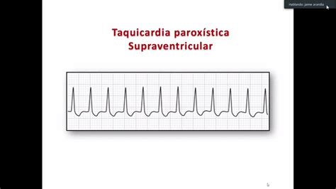 Medicina Interna Taquicardia Paroxistica Supraventricular Youtube