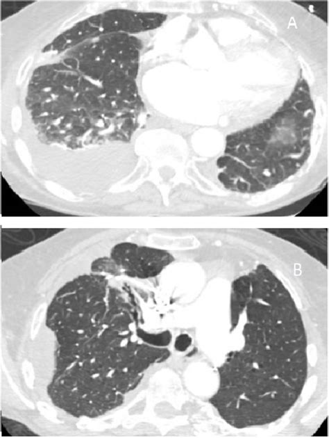 Computed Tomography Angiogram Of The Chest Revealing Post Right Upper