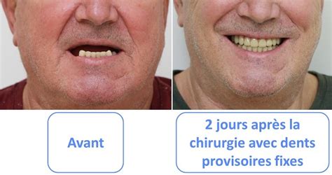 Charge Imm Diate Sur Implant Dentaire Des Dents Provisoires Directement