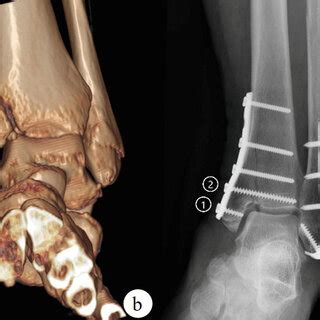 The Use Of Buttress Steel Plates To Assist Screw Fixation Can Eliminate