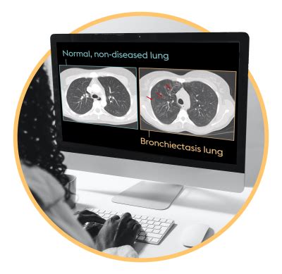 Bronchiectasis Symptoms Diagnosis Treatment Afflovest