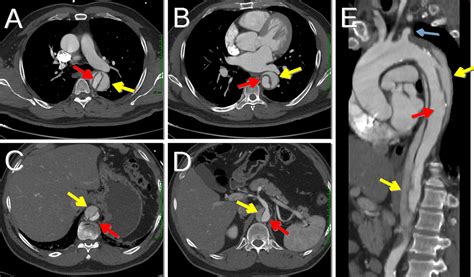 Stanford B Aortic Dissection