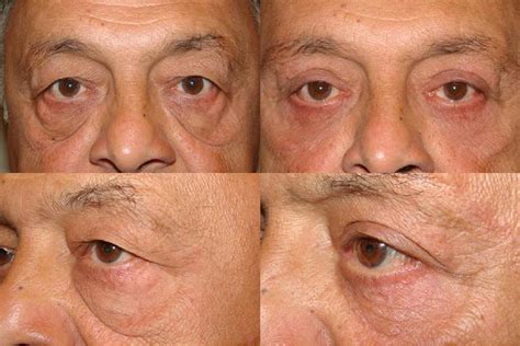 Canthoplasty Dr Guy Massry