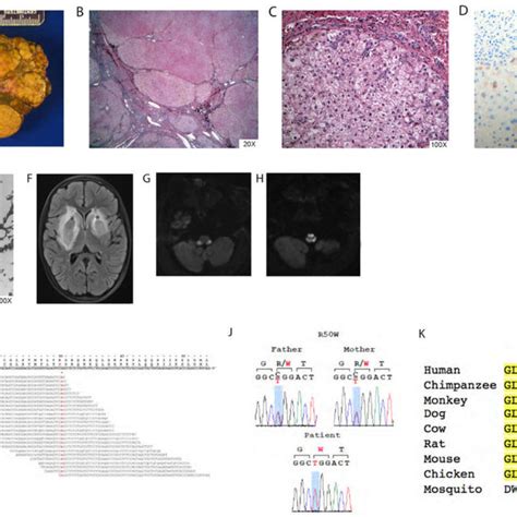 Liver Histological Radiological And Genetic Findings In Patient 1 A