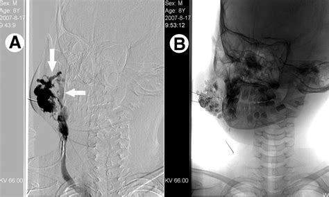 Digital Subtraction Angiography Guided Percutaneous Sclerotherapy Of