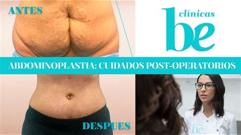 Abdominoplastia o cirugía de abdomen cuidados post operatorios