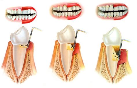 PIORREA O MALATTIA PARODONTALE Il Tuo Dentista A Reggio Calabria