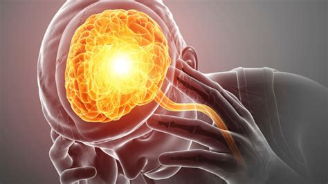 Enxaqueca: aprenda a identificar - Blog de Medcof: conteúdos, editais ...