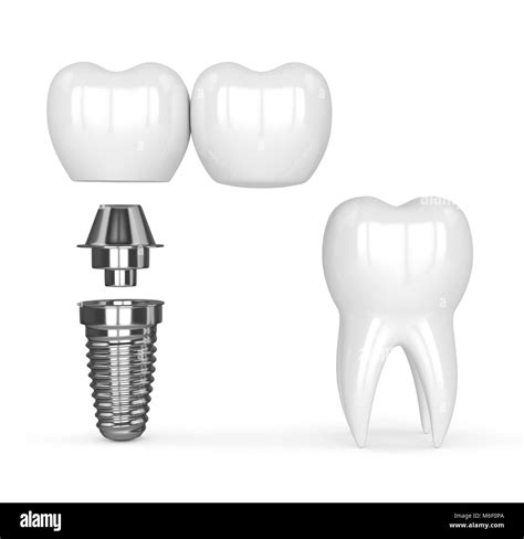 Cantilever Dental Implant At Thomas Gabaldon Blog