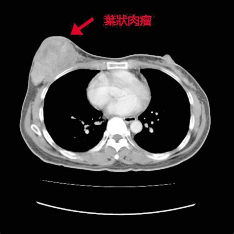 胸長腫塊 拖3年長到12公分 自由健康網
