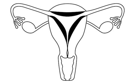 Ilustración diagramática de la anatomía de la hiperplasia endometrial