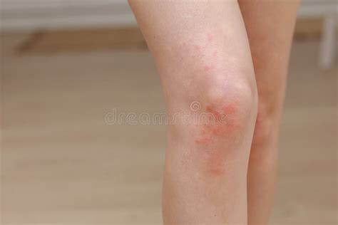 Skin Allergies Legs Skin Women Closeup Of Red Pustules On A Knee An