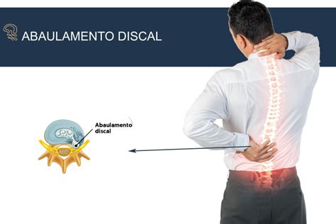 Abaulamento Discal Dr Guilherme Rossoni