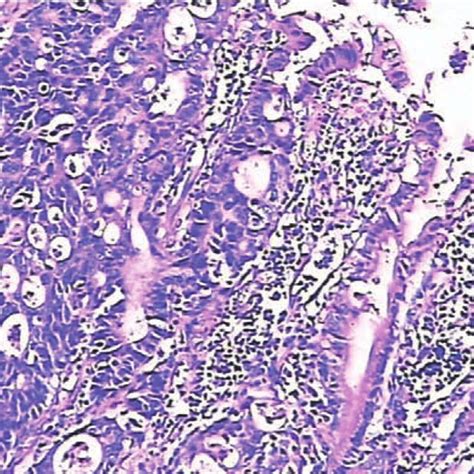 Figure4 A Moderately Differentiated Adenocarcinoma Oncocyte Was Noted Download Scientific